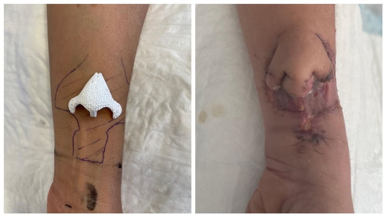 Esta es una realidad gracias a una nariz personalizada e impresa en 3D, hecha de un bimetal especial que logra reemplazar el valioso cartílago.