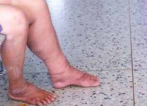 La retención de líquidos se da debajo de los tejidos.