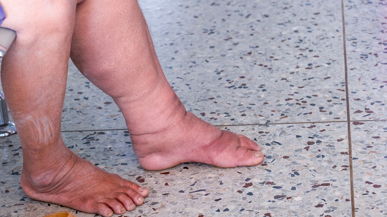 La retención de líquidos se da debajo de los tejidos.