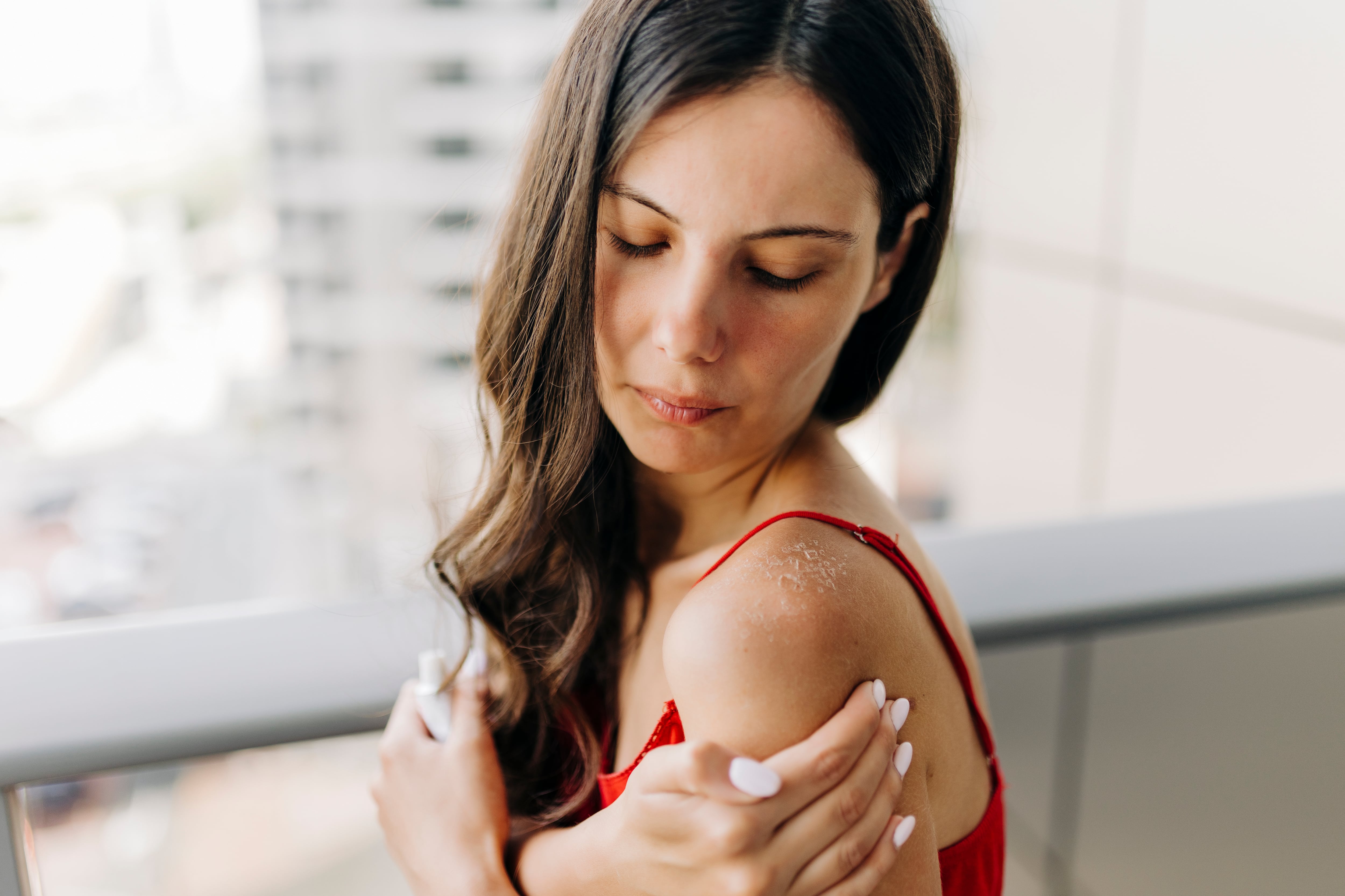 Quemadura por el sol