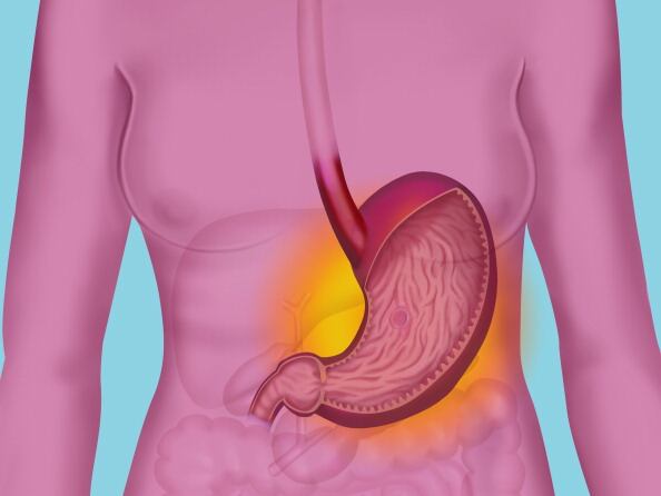 La gastritis es un grupo de enfermedades que tienen en común la inflamación del revestimiento del estómago, que se produce por la misma infección bacteriana y que es causada por la mayoría de las úlceras estomacales, el uso habitual de ciertos analgésicos e incluso por ingerir bebidas alcohólicas.  (Photo By BSIP/UIG Via Getty Images)