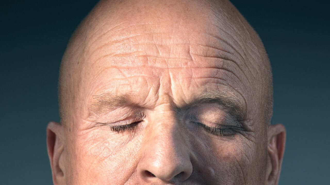 La alopecia ocasiona parches redondos de pérdida del cabello y puede llevar a la calvicie total.