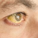 HepaLa ictericia es una enfermedad relacionada con daños en el hígadotitis related jaundice