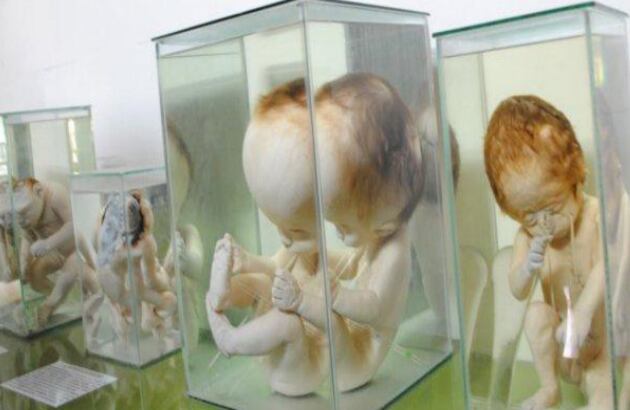 Los fetos con hidrocefalia y malformaciones cerebrales y craneales son algunas de las piezas más impresionantes del Museo del Cerebro en Lima