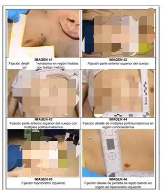 La Fiscalía reveló detalles de la necropsia hecha al cuerpo de Juan Pablo González, el presunto abusador de Hilary. Más de 50 golpes y fracturas.