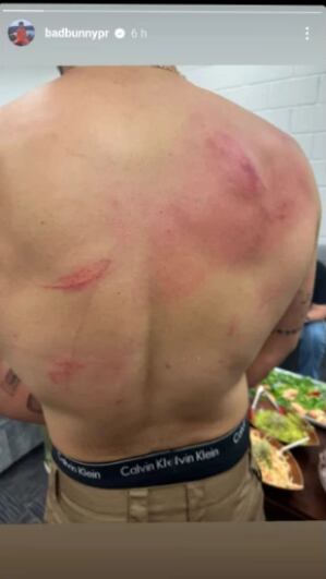 Así terminó la espalda de Bad Bunny tras su pelea en la WWE.