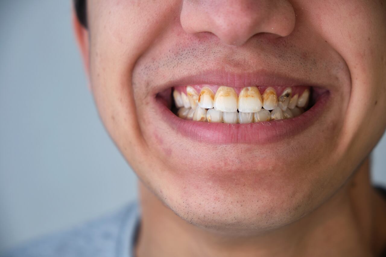 La placa bacteriana de los dientes se endurece hasta convertirse en sarro.