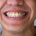 La placa bacteriana de los dientes se endurece hasta convertirse en sarro.