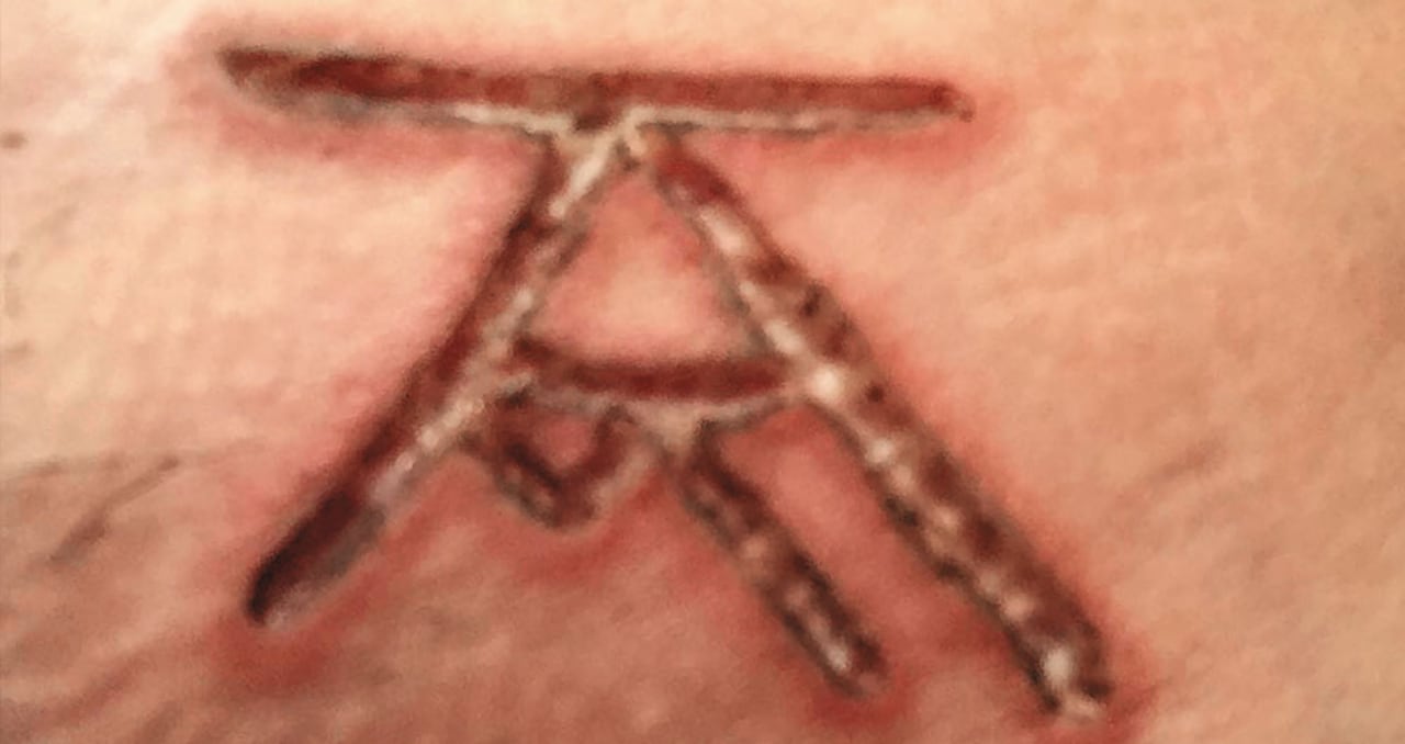 La marca con que Raniere identificaba a sus esclavas. Ellas aseguran que él sentía placer viendo el cruel proceso y les acariciaba la cicatriz cuando tenían sexo.