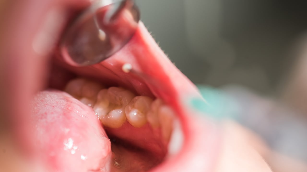 Caries: esta es la lista de alimentos que mas la producen