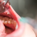 Caries: esta es la lista de alimentos que mas la producen