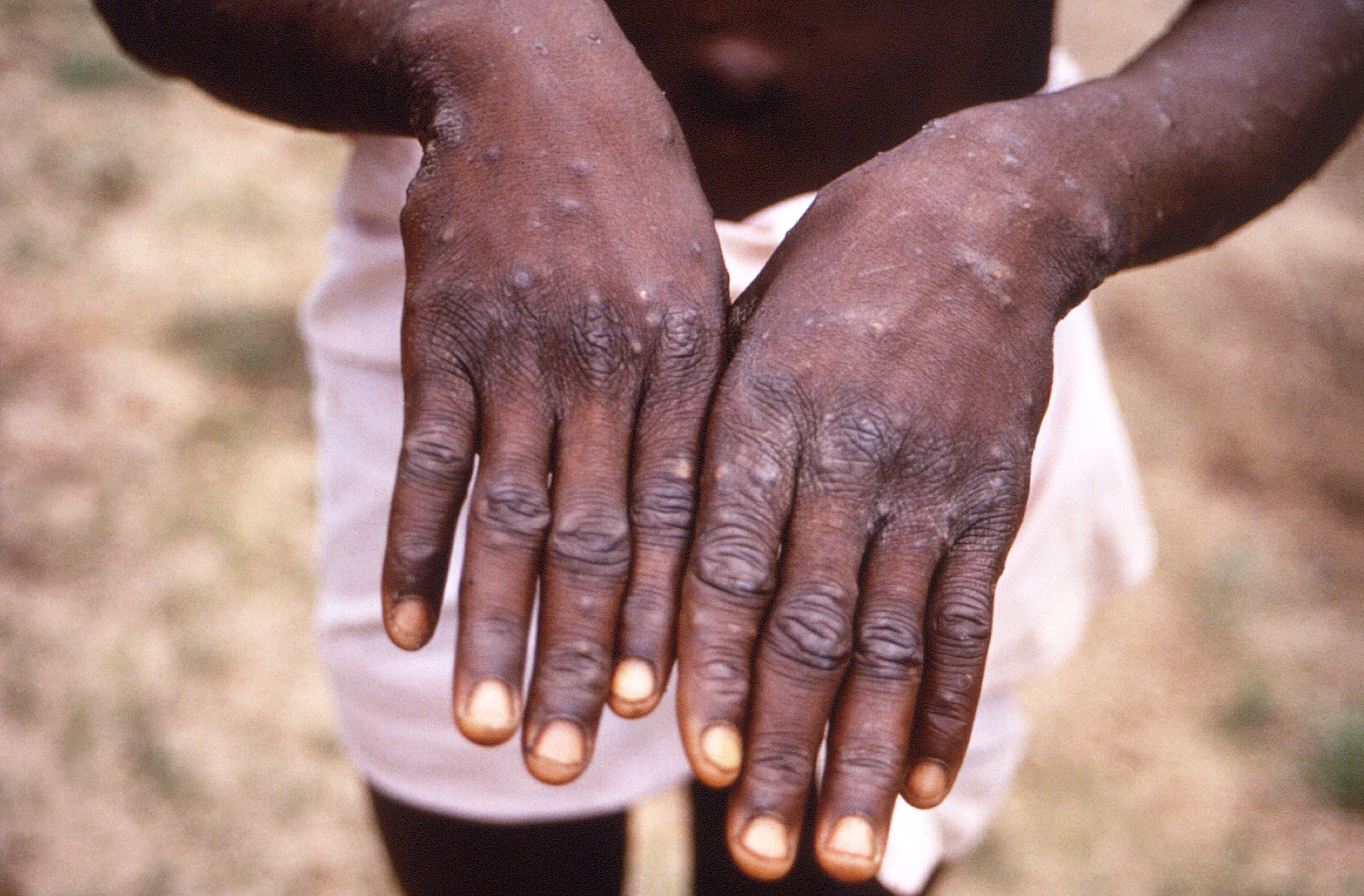 Primer plano de las lesiones de viruela simica en las manos de un paciente durante la etapa de recuperación del virus, República Democrática del Congo, 1997. Cortesía de CDC/Mahy et al. (Foto vía Smith Collection/Gado/Getty Images)