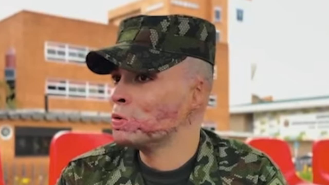 El subteniente del Ejército Nacional de Colombia Miguel Ángel Mejía, quien sobrevivió a fuertes quemaduras.
