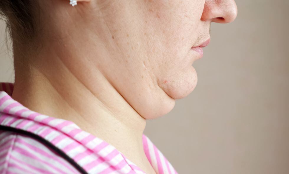 El exceso de peso es una de las principales causas de la papada.