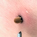 Foto de referencia sobre garrapatas en la piel