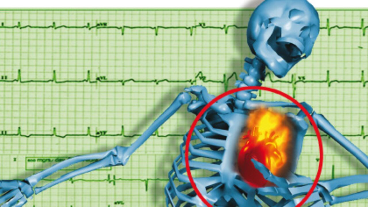 El estrés podría ser responsable del riesgo de infarto.