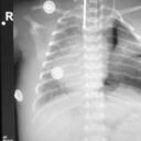 Paciente recién nacido fue tratado con terapia ECMO, un hito en la medicina colombiana.