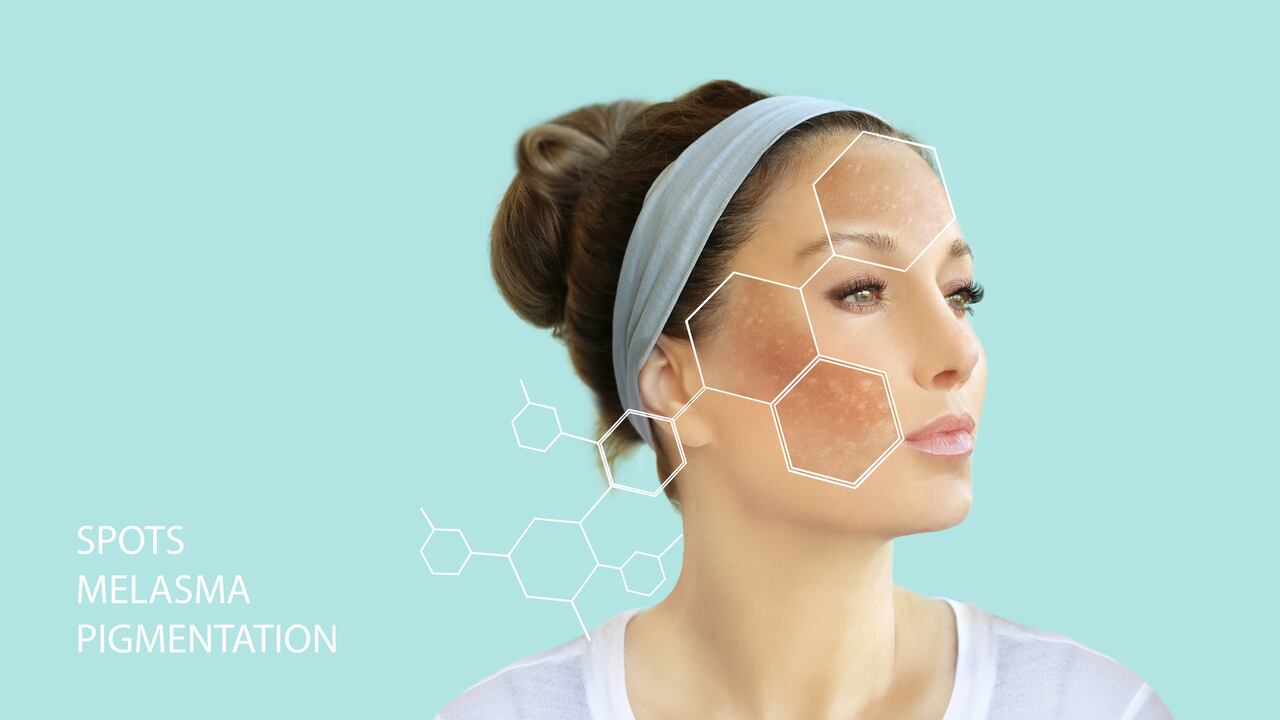 Los melasmas pueden ser consecuencia del sol, el embarazo o la ingesta de pastillas anticonceptivas.