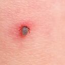 Foto de referencia sobre garrapatas en la piel