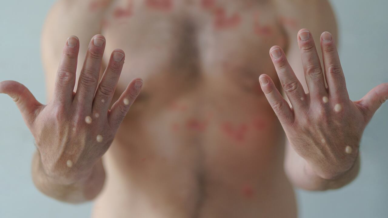 Un caso de mpox más agresivo fue detectado en Colombia, bajo vigilancia sanitaria.