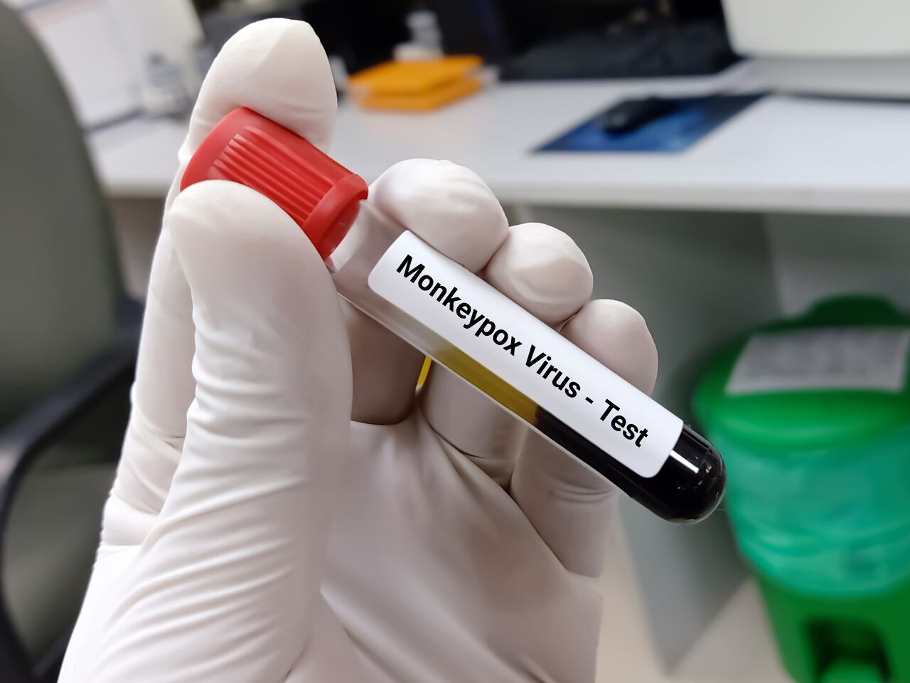 En Colombia se han reportado 4.049 casos de viruela símica.