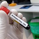 En Colombia se han reportado 4.049 casos de viruela símica.