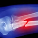 Expertos aconsejan tener cuidado con los productos ricos en oxalatos, los cuales pueden dificultar la absorción de calcio para los huesos. Foto: Getty images.