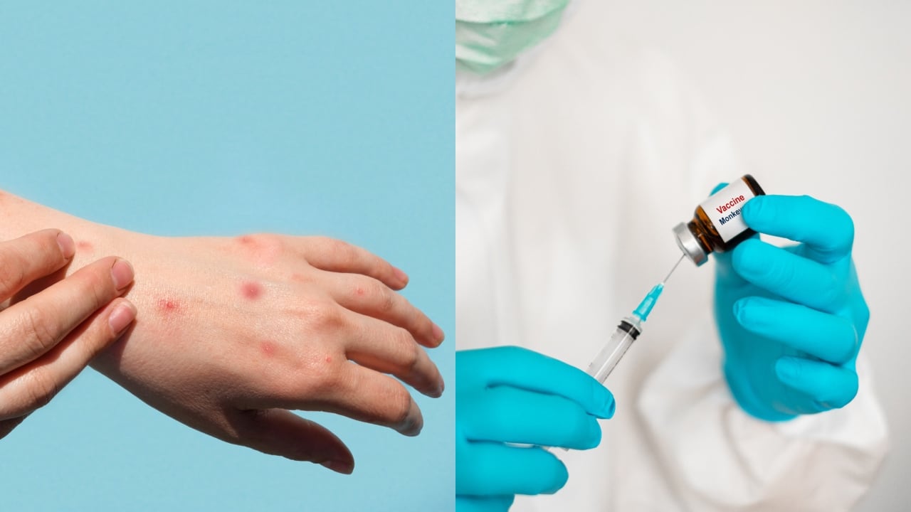 OMS aprueba vacuna contra viruela del mono.