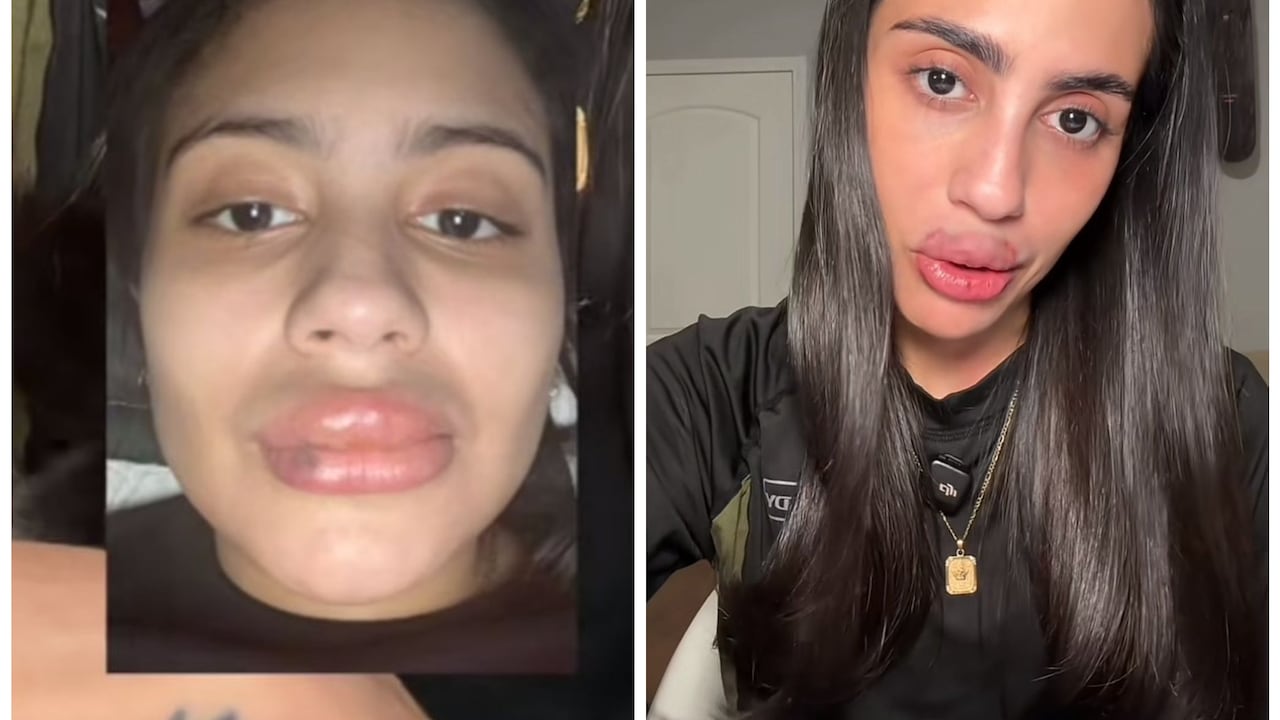 La influencer Hillary denunció que fue víctima de un mal procedimiento estético.