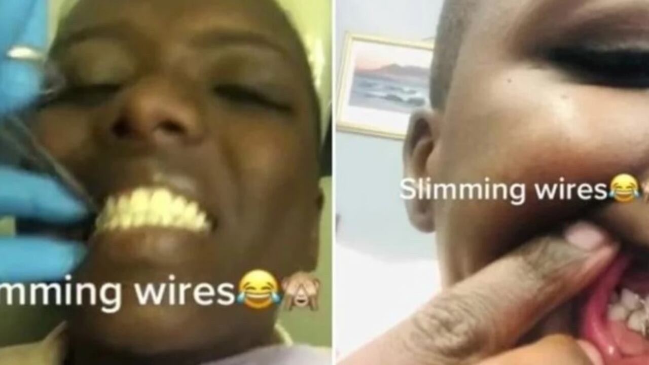 La sudafricana Aviwe Mazosiwe contó cómo fue el proceso de coserse la boca para evitar consumir alimentos sólidos.