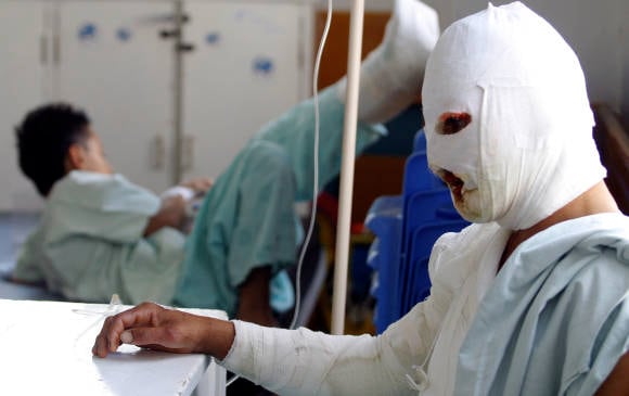 Para evitar la acción de las autoridades  algunos padres de niños quemados con pólvora les ponen en las heridas pomadas caseras, los ponen en agua o les dan pastas para el dolor que compran en droguerías y no dimensionan que el daño puede ser serio.