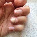 Remedios caseros para las uñas amarillas y gruesas.