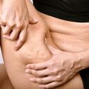 El factor genético puede incidir en el desarrollo de celulitis.