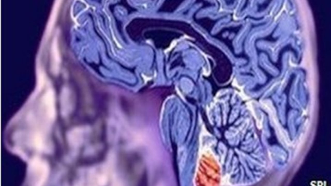 El aneurisma puede estallar con un súbito incremento de la presión arterial.