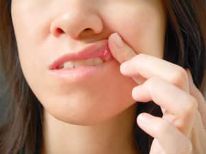 Dolor de canker en la mujer labio superior