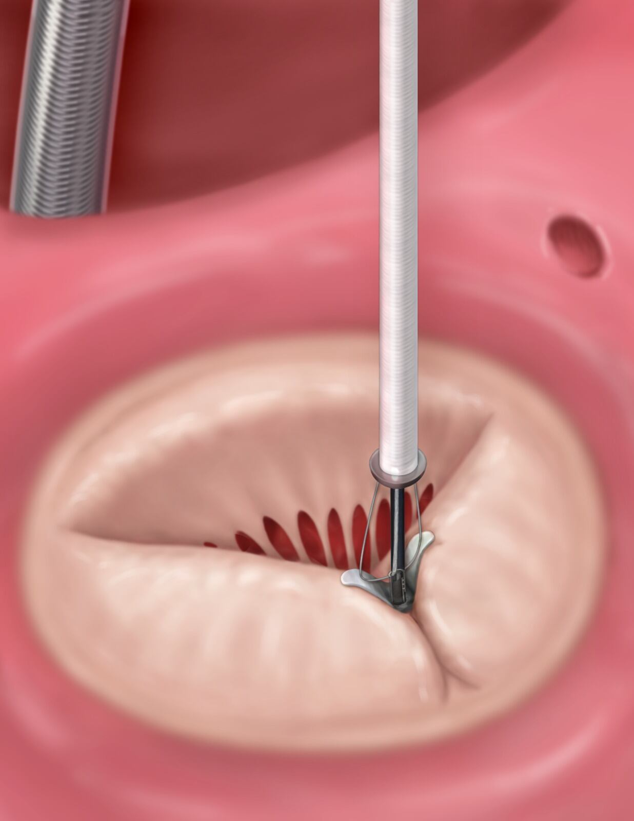 dispositivo para la regurgitación de la válvula tricúspide