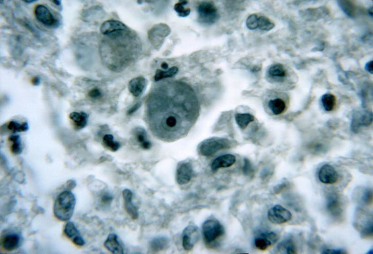 Naegleria Fowleri.