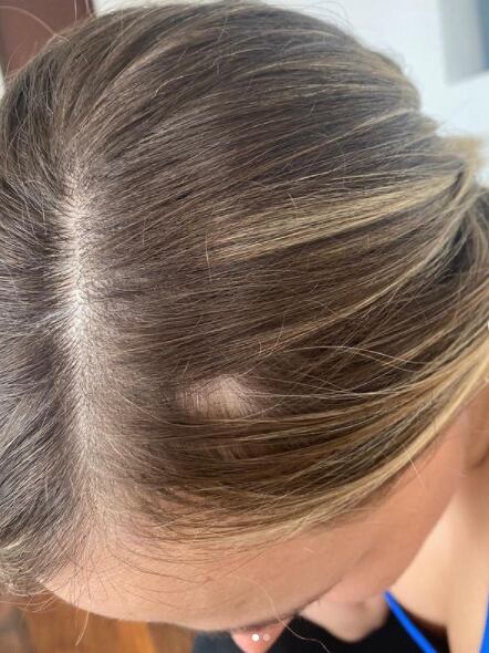 Elizabeth Loaiza mostró la caída de su cabello tras quimioterapias.