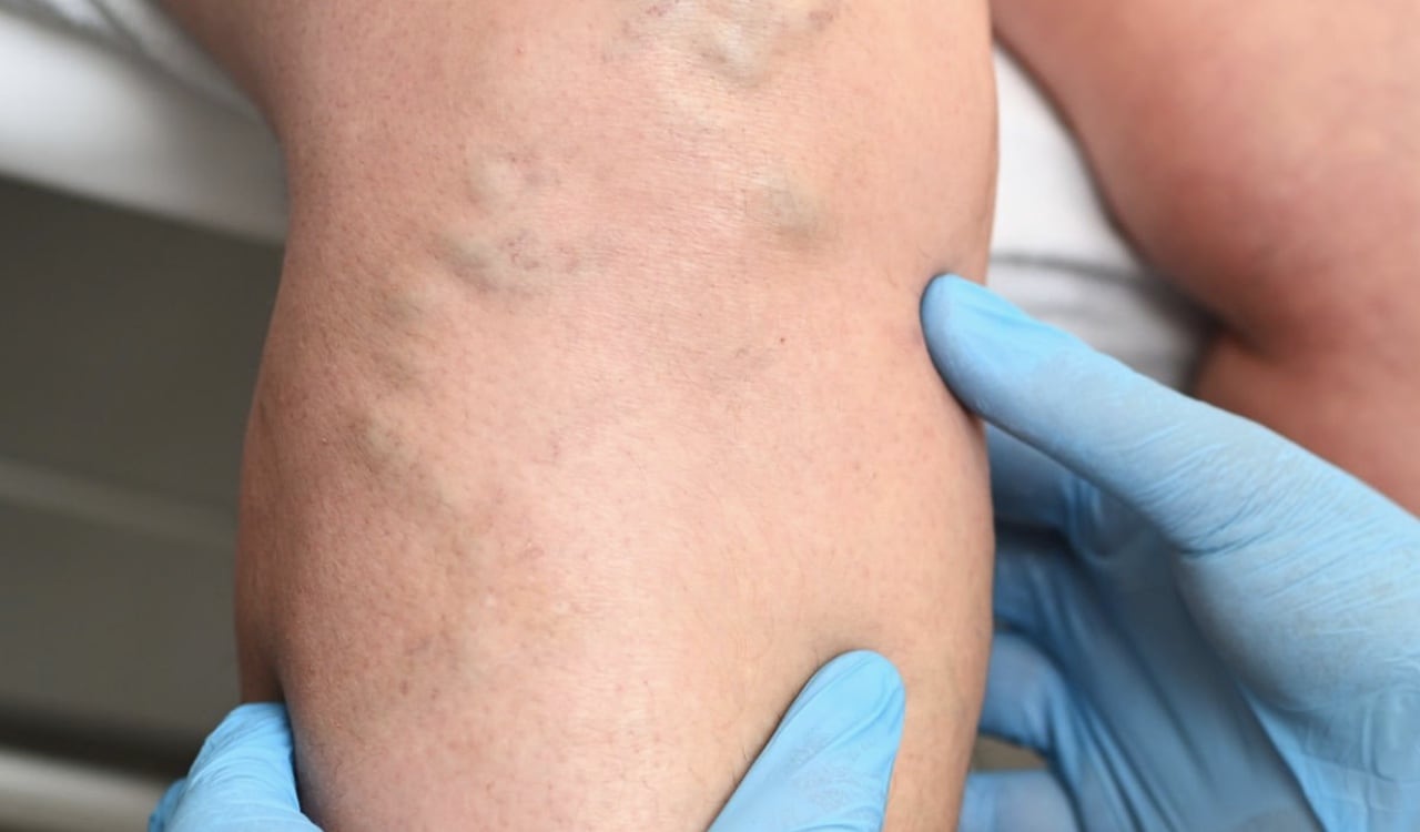 El consumo regular de vitamina E ayuda a mejorar los coágulos en la sangre.