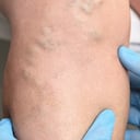 El consumo regular de vitamina E ayuda a mejorar los coágulos en la sangre.