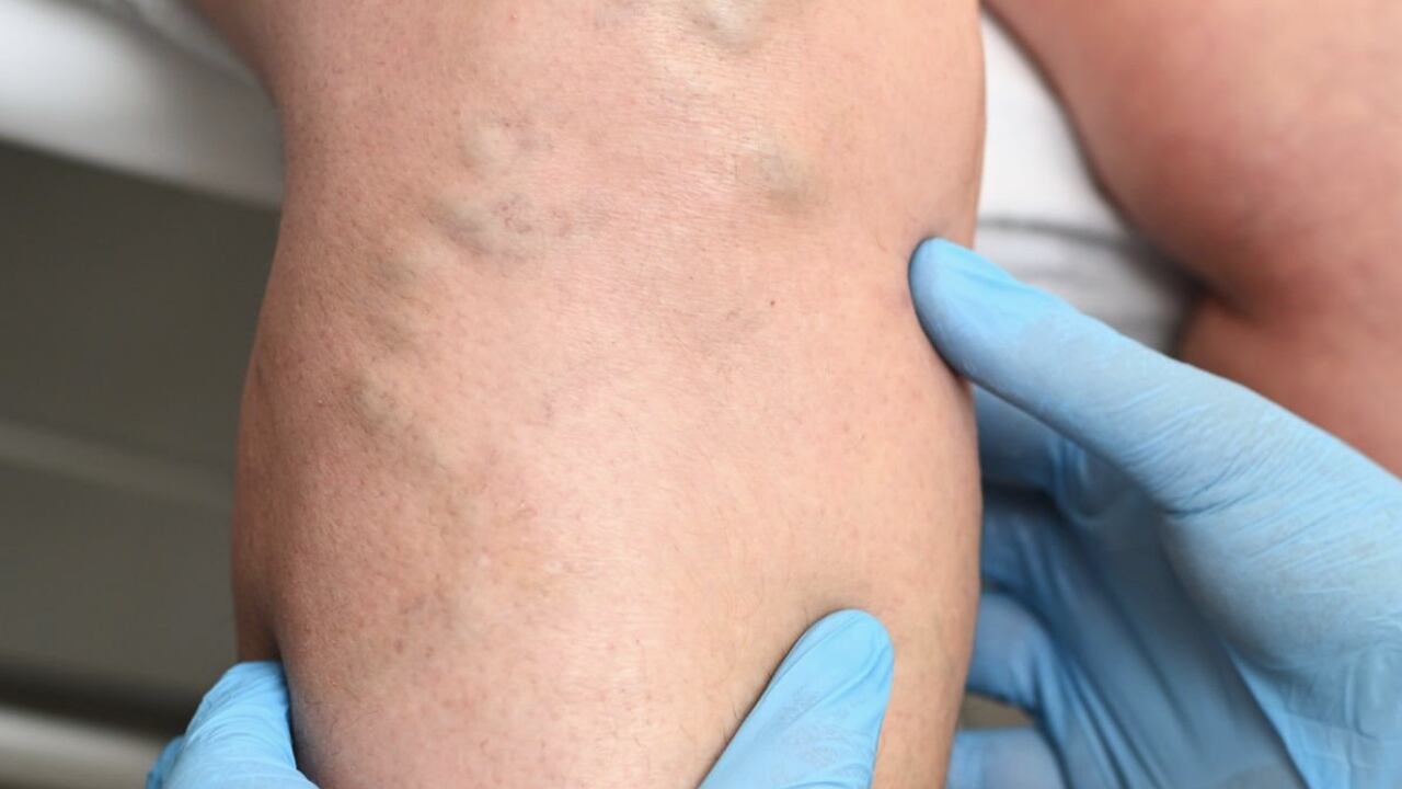 El consumo regular de vitamina E ayuda a prevenir los coágulos en la sangre.