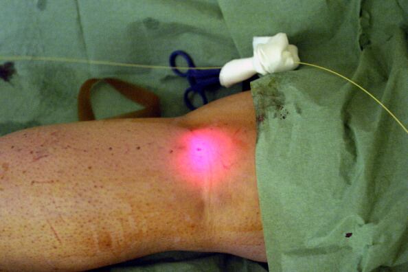 Así mismo, se recurren a otros tratamientos como dióxido de carbono, radiofrecuencia, ultrasonido, cremas y lociones y dispositivos de masaje profundo.(Photo By BSIP/UIG Via Getty Images)