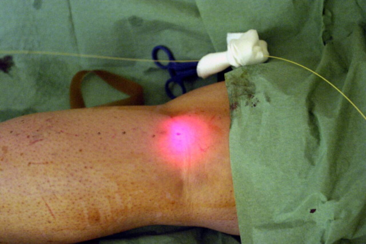 Así mismo, se recurren a otros tratamientos como dióxido de carbono, radiofrecuencia, ultrasonido, cremas y lociones y dispositivos de masaje profundo.(Photo By BSIP/UIG Via Getty Images)