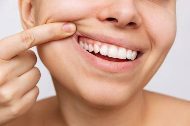 Los beneficios del tratamiento periodontal están dirigidos a resolver el proceso inflamatorio localizado en boca, ofreciendo un beneficio en doble vía, ya que con esto se disminuye el riesgo de complicaciones que puede tener la población con Diabetes al favorecer la reducción de la Hemoglobina Glicosilada, componente importante en el control de esa enfermedad.