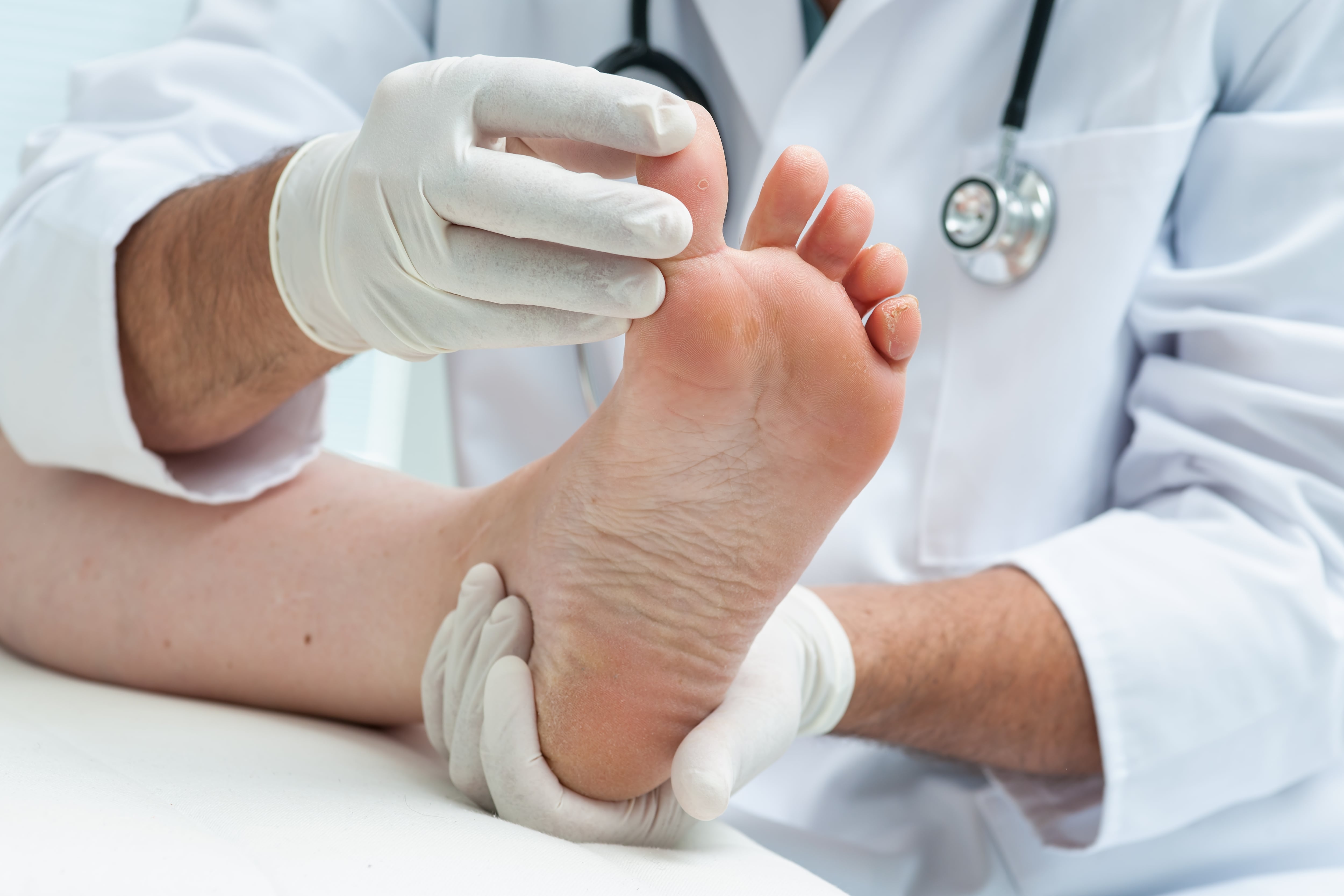 Doctor dermatologist examines the foot on the presence of athlete's foot