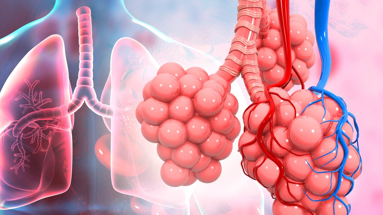 La bronquitis crónica está catalogada dentro de las EPOC (Enfermedad Pulmonar Obstructiva crónica).