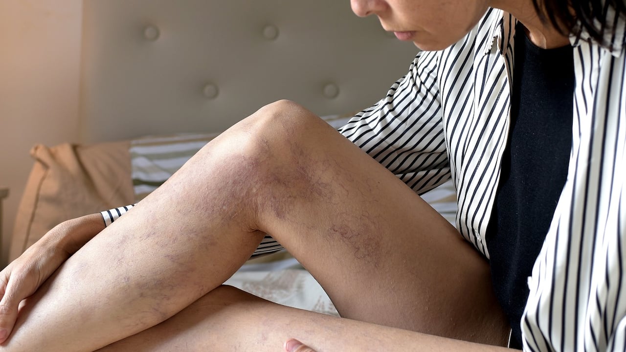 Este problema afecta a más mujeres que hombres, con el paso del tiempo y, si no se cuidan adecuadamente, puede generar molestias e incluso dolor.