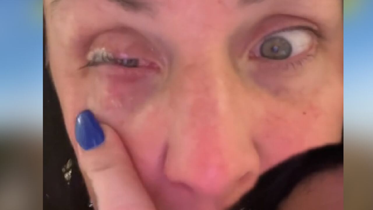 Mujer aplicó accidentalmente en su ojo pegamento para uñas pensando que era gotas oculares