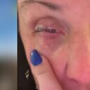 Mujer aplicó accidentalmente en su ojo pegamento para uñas pensando que era gotas oculares