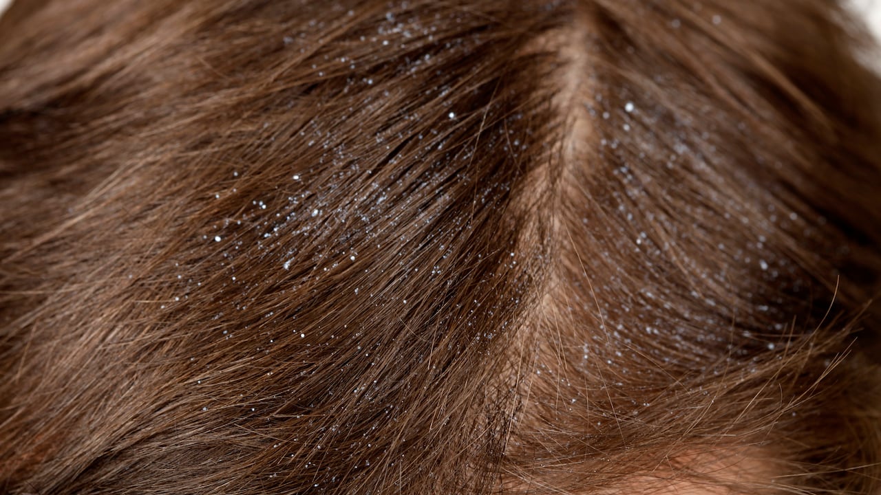 La caspa es un problema que la mayoría de personas han experimentado en algún momento de su vida.